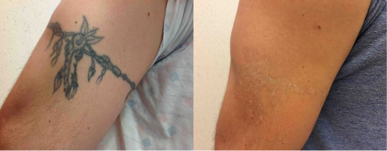 Before and after of a Male patient treated with Laser Tattoo Removal on arm