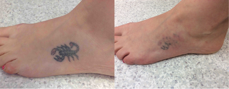 Before and after of a Female patient treated with Laser Tattoo Removal on top of foot.