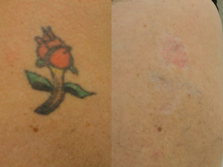 Before and after of a Female patient treated with Laser Tattoo Removal on shoulder blade.