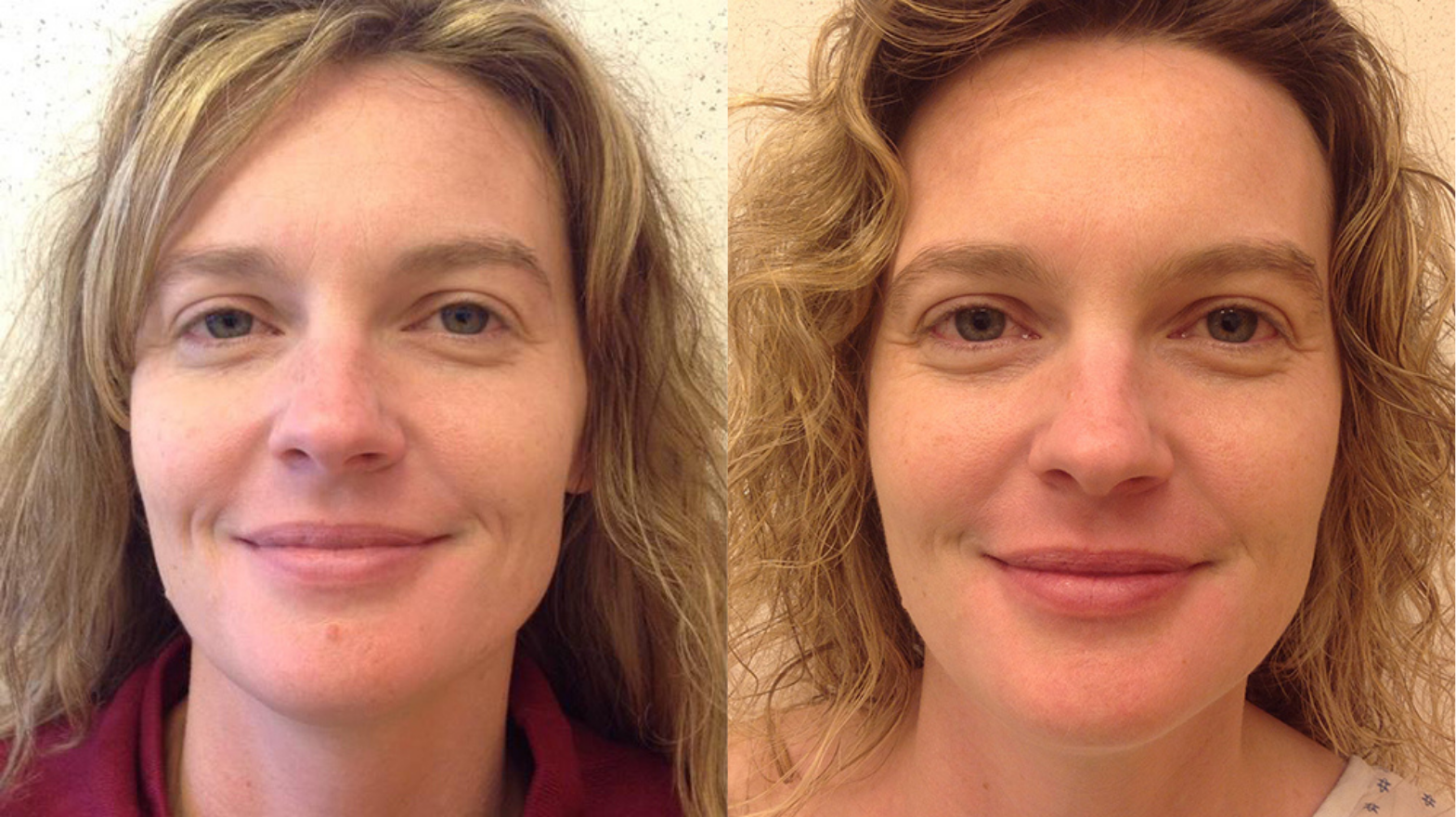 Before and after of a A 37-year-old Female patient treated for Mole Removal located on the chin.