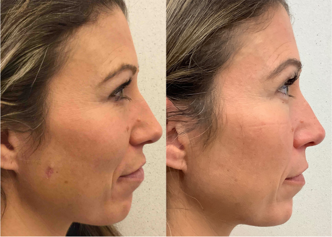 Before and after of a 41-year-old Female patient treated for Mole Removal on upper right jawline.