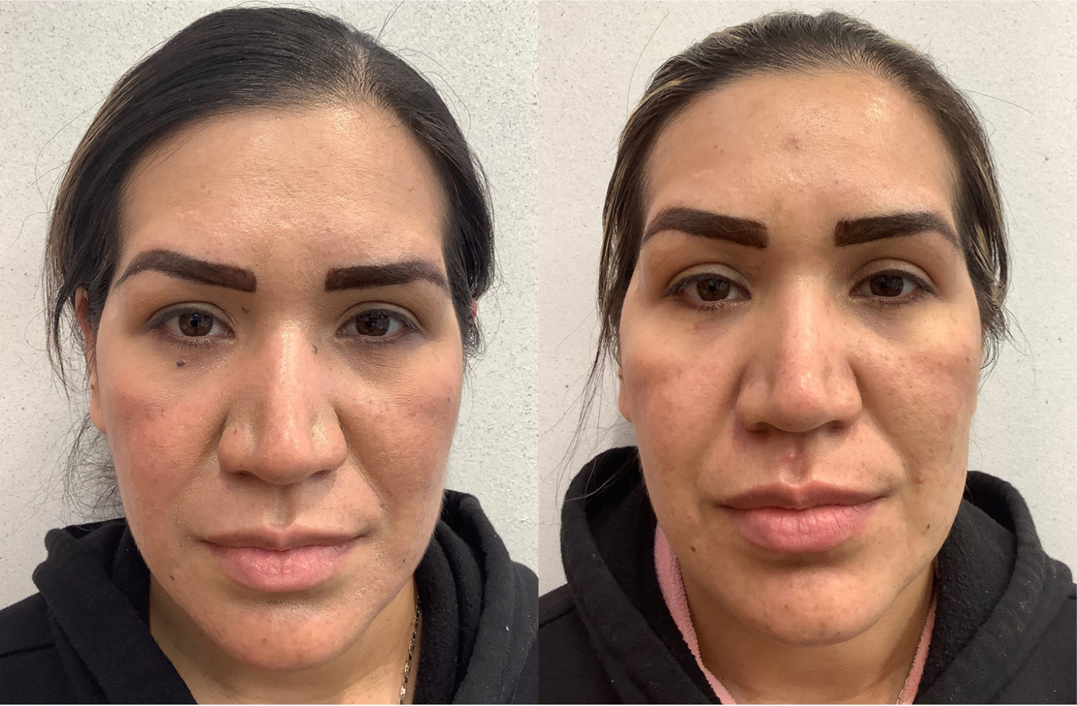 Before and after of a Female patient treated for Mole Removal on multiple areas; left bridge of nose, right under eye and interior areas.