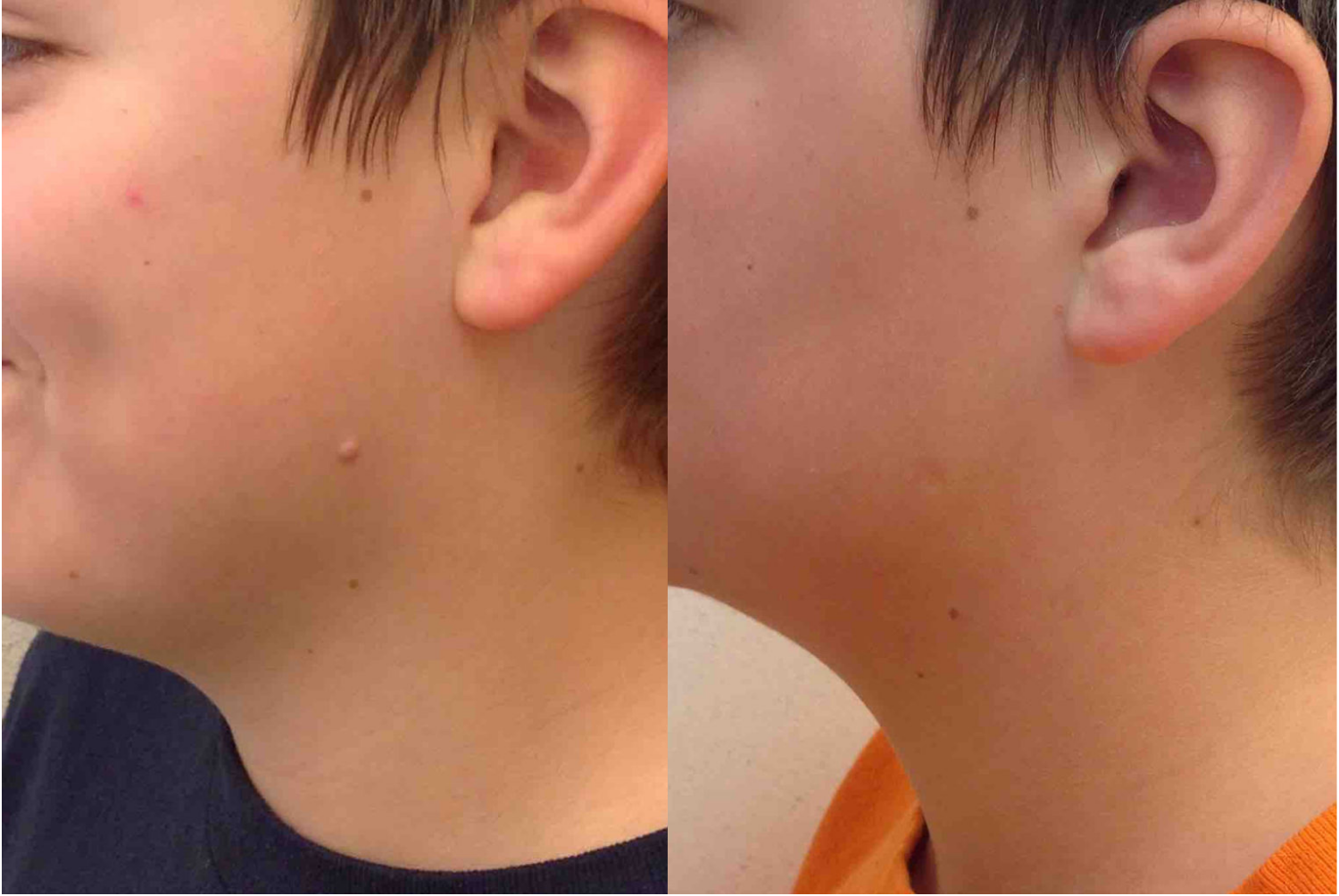 Before and after of a 13-year-old Male patient treated for Mole Removal located on upper left jawline.