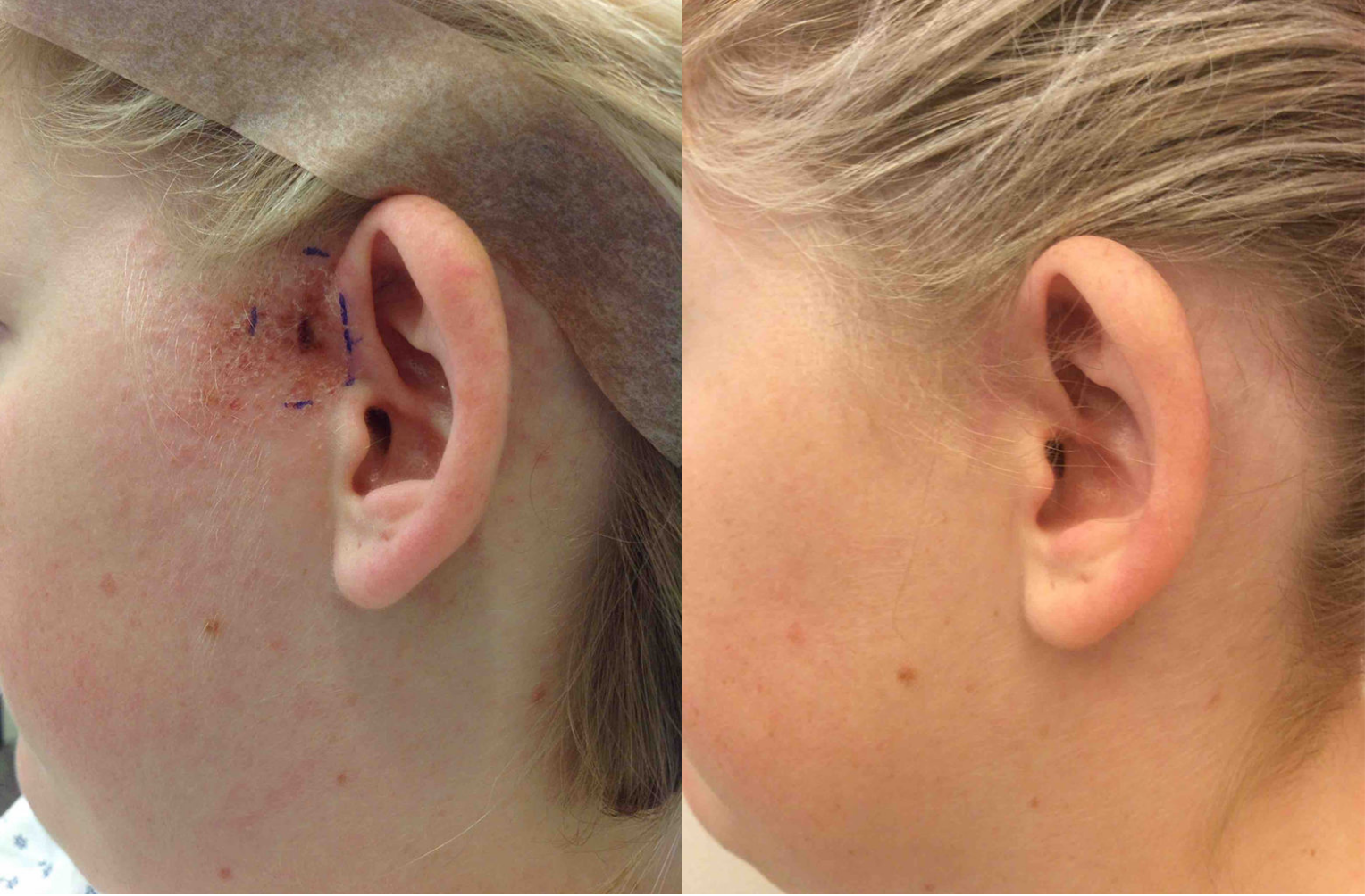 Before and after of a 25-year-old Female patient treated for Mole Removal located on the left preauricular.