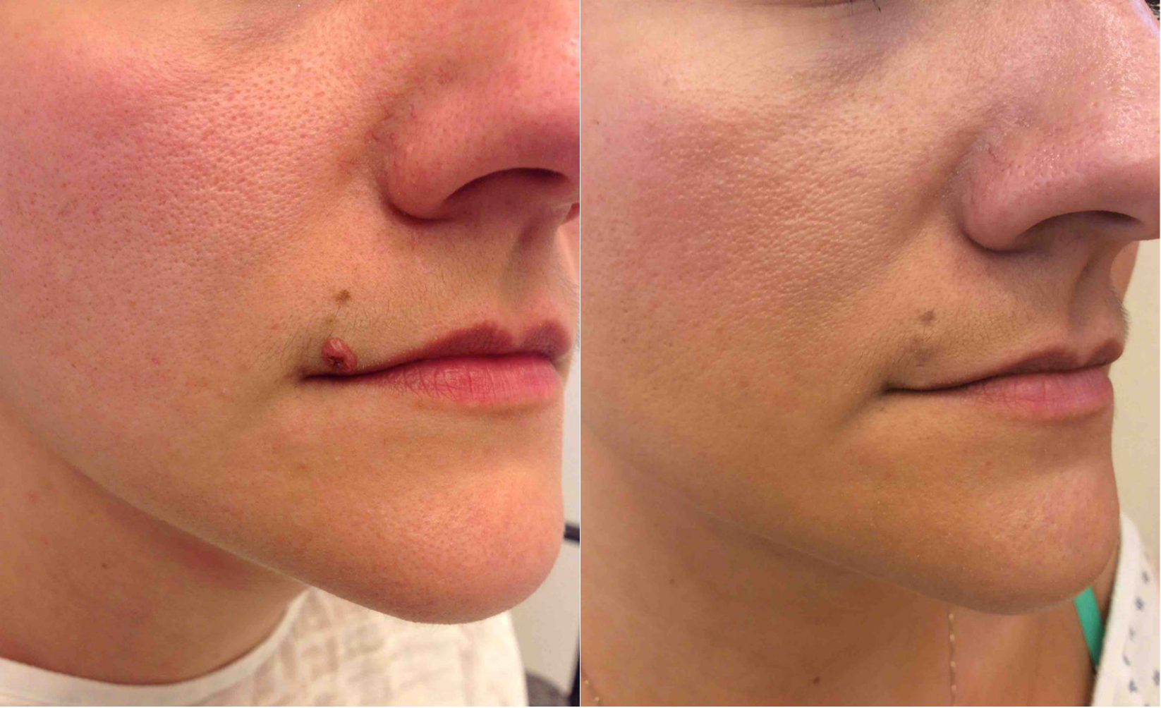 Before and after of a a 31-year-old Female patient treated for Mole Removal located on the upper lip.