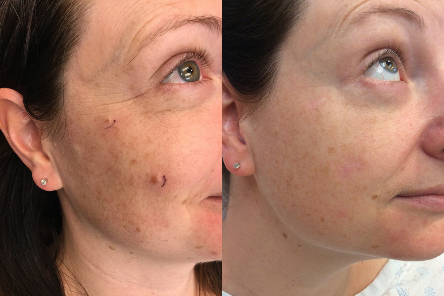 Before and after of a 37-year-old Female patient treated for Mole Removal on two areas located on right cheek.