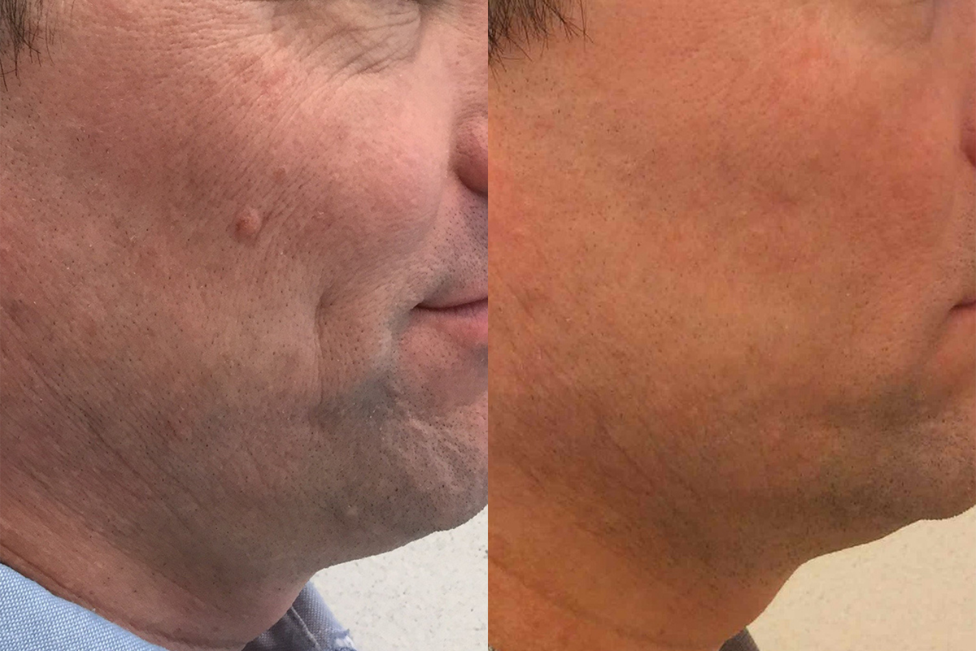 Before and after of a male patient treated for Mole Removal located on right cheek.