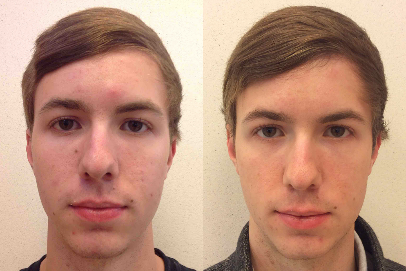 Before and after of a 21-year-old Male patient treated for Mole Removal located on the right cheek.