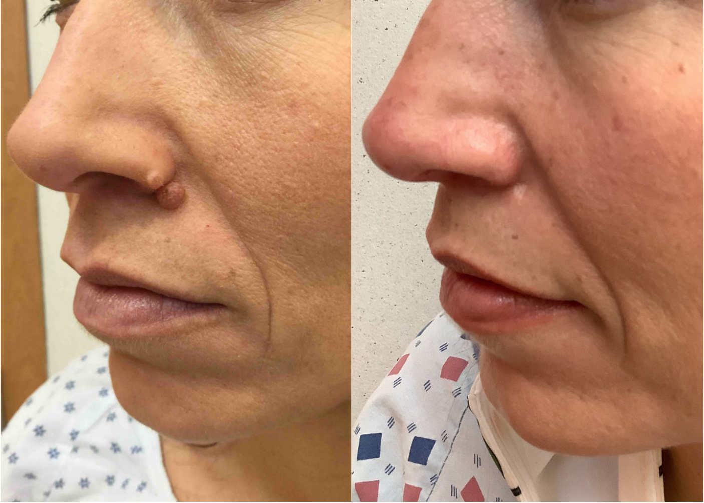 Before and after of a 41-year-old Female patient treated for Mole Removal under nose.