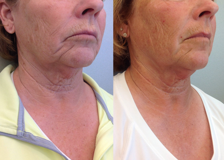 Before and after of a 52-year-old Female patient who was treated in LovelySkin Spa with Full Face Pelleve