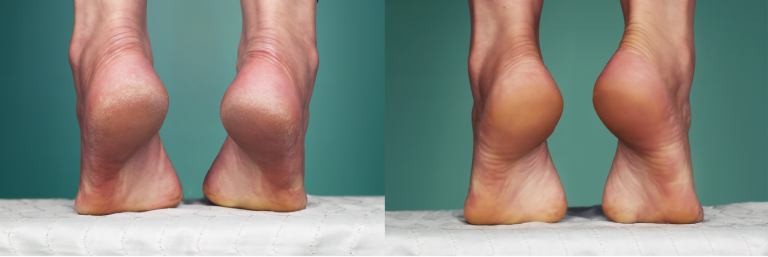 Before and after of Female patient treated with the Patchology Posh Peel Pedi Cure Intensive Foot Peel Treatment 