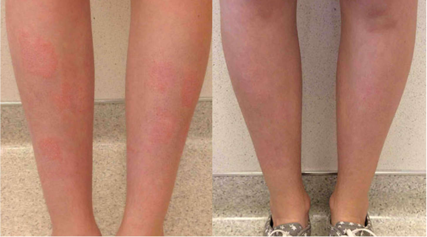 Before and after of a 31-year-old Male patient treated for Psoriasis located on legs, results; Three Months Post Treatment.