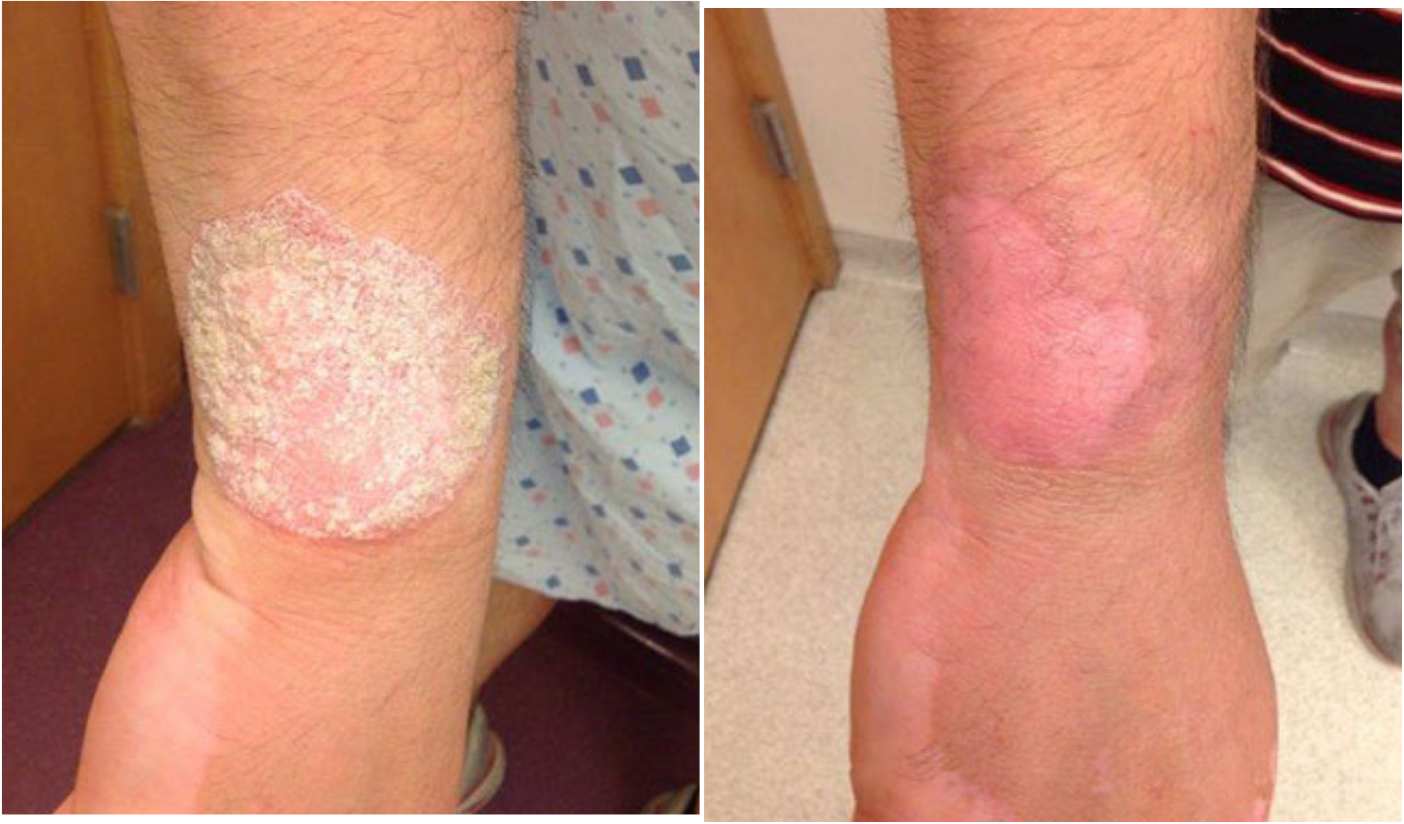 Before and after of a Male patient treated for Psoriasis located on wrist, results; Three Months Post Treatment.