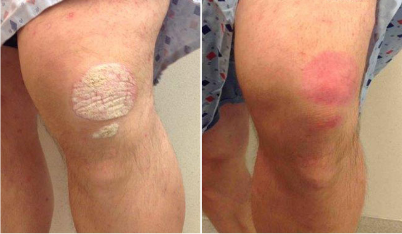 Before and after of a Male patient treated for Psoriasis located on knees, results; Three Months Post Treatment.