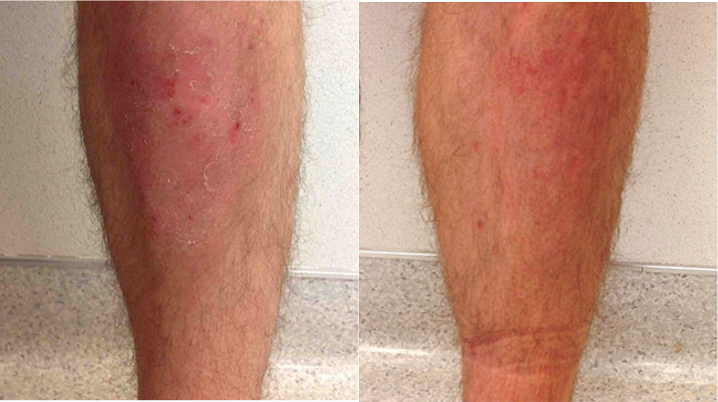 Before and after of a Male patient treated for Psoriasis located on knees, results; Three Months Post Treatment.