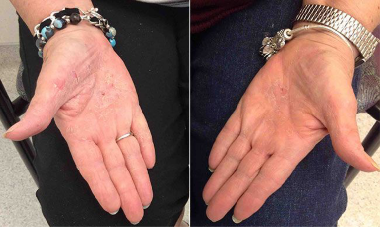 Before and after of a Female patient treated with the Excimer Laser to improve the appearance of Psoriasis