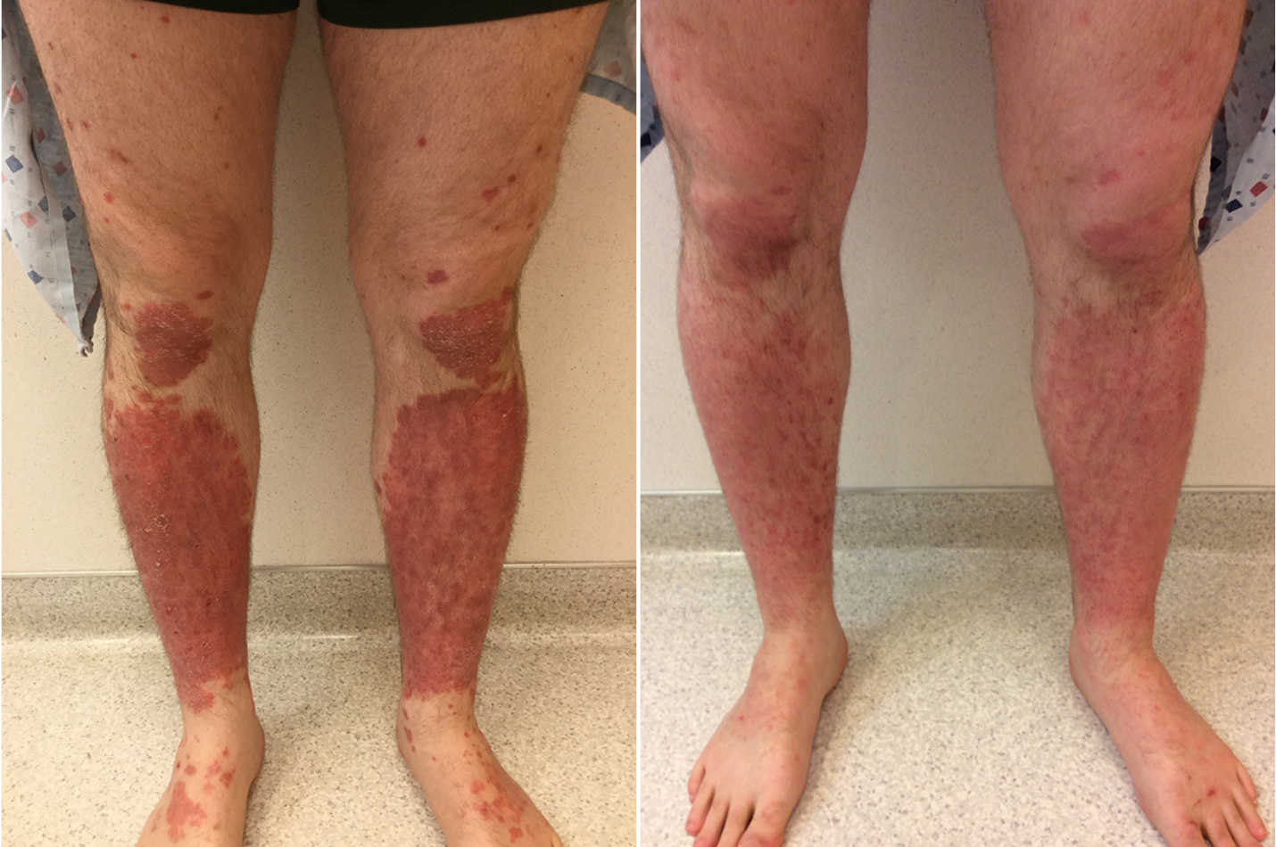 A 25-year-old Male patient treated for Psoriasis located on chest and back, results; Two Months Post Treatment with Biologic Cosentyx.