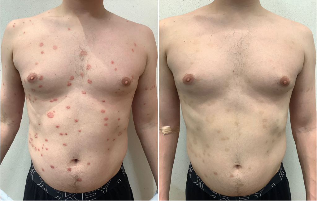 Psoriasis Treatment Before and After