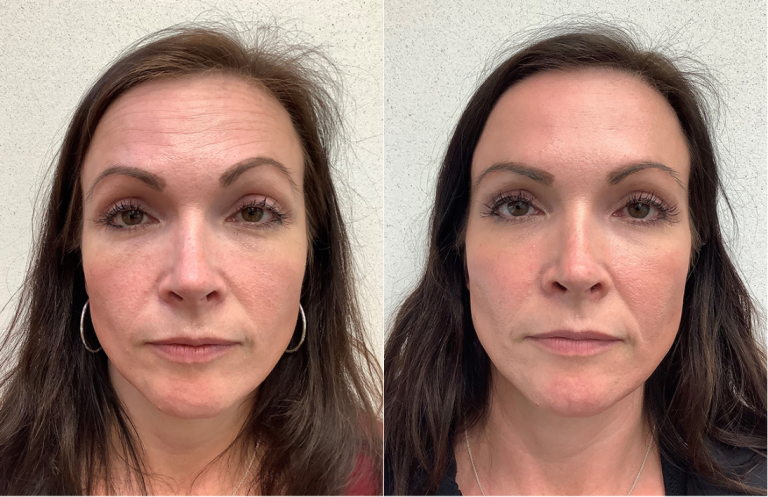 Before and after of a 40-year-old Female treated with RHA Collection of Fillers