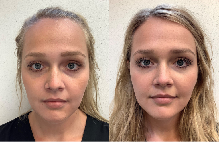 Before and after of a 21-year-old Female treated with RHA Collection of Fillers 