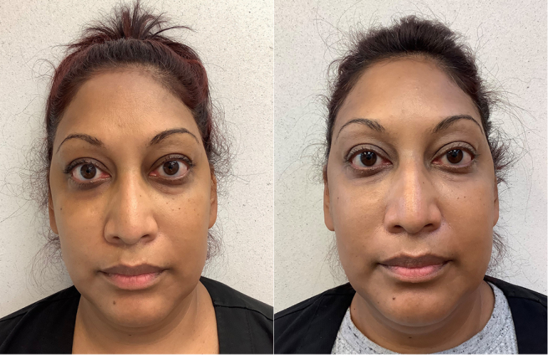 Before and after of a 45-year-old Female treated with RHA Collection of Fillers