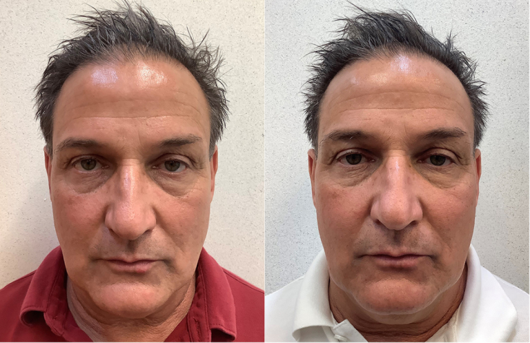 Before and after of a 58-year-old Male treated with RHA Collection of Fillers