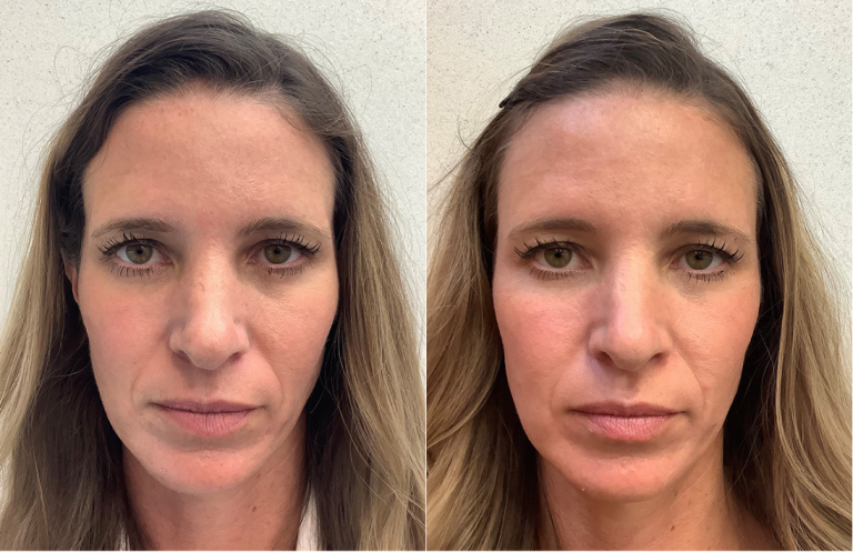 Before and after of a 36-year-old Female treated with RHA Collection of Fillers