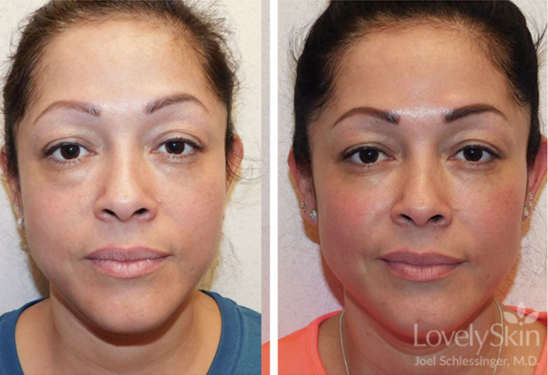 Before and after of a 40-year-old Female patient treated with Restylane Filler 