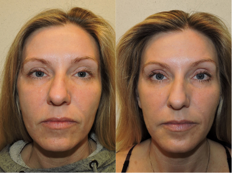 Before and after of a 42-year-old Female patient treated with Restylane Filler