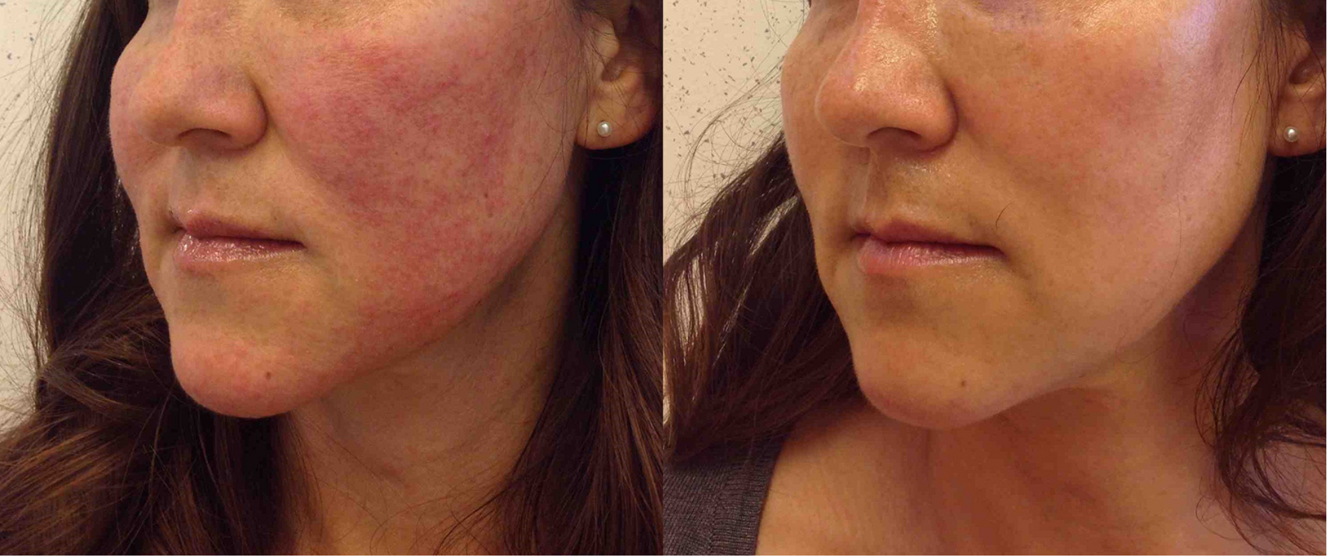 Before and after of a 45-year-old Female patient treated for Rosacea located on the face, results; Four Months Post Treatment.