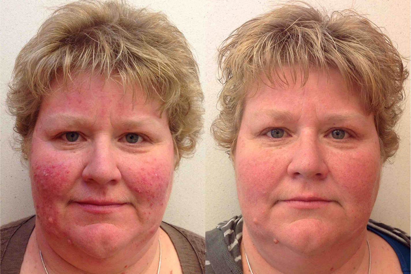 Before and after of a 41-year-old Female patient treated for Rosacea located on the face, results; Seven Months Post Treatment.