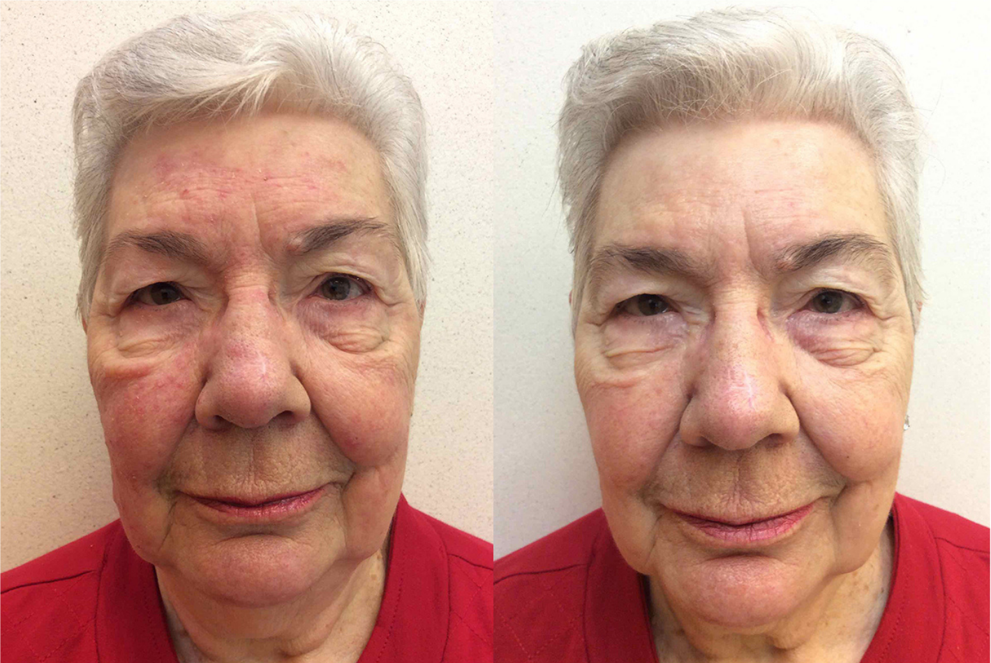 Before and after of a 78-year-old Female patient treated for Rosacea located on the face, results; One Month Post Treatment.