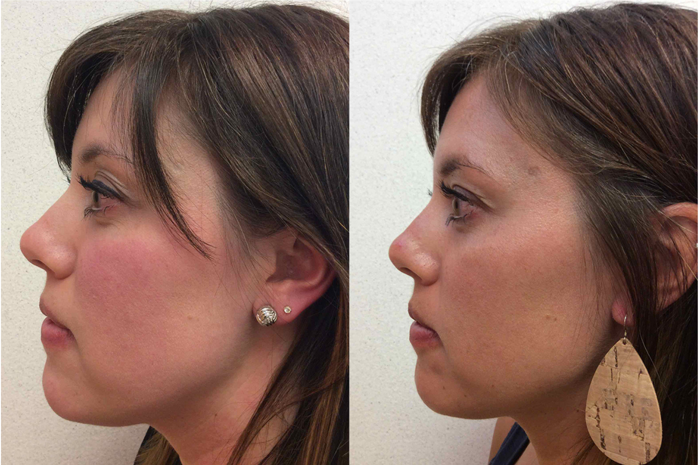 Before and after of a 35-year-old Female patient treated for Rosacea located on the face, results; Three Months Post Treatment.