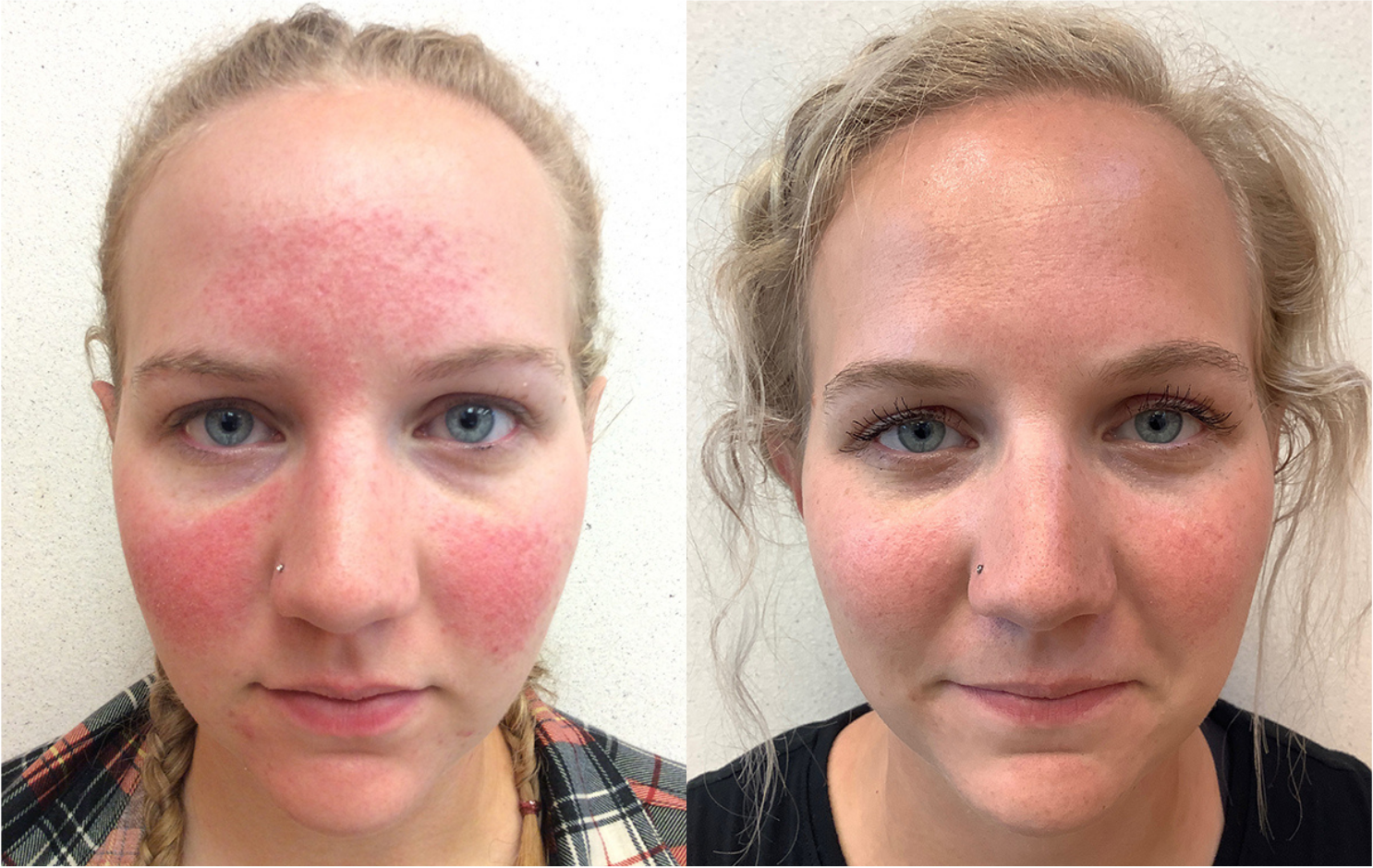 Before and after of a 27-year-old Female patient treated for Rosacea located on the face, results; Four Months Post Treatment.