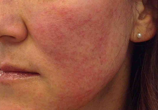 Rosacea on face