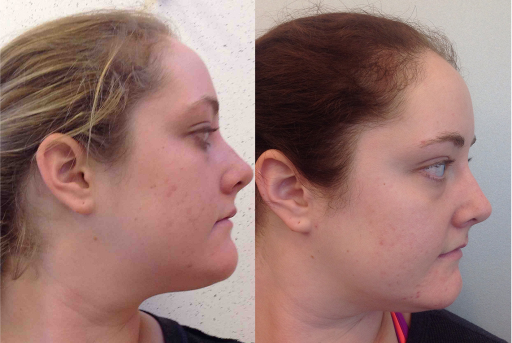 Before and after of a 26-year-old female who was treated with Antibiotics and IPL Laser to improve the appearance of acne, overall skin texture and acne scarring.