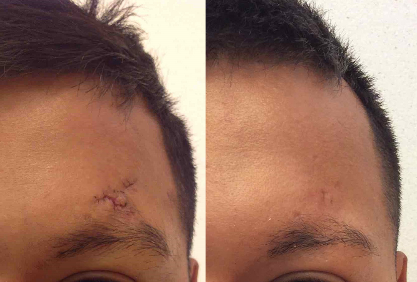 Before and after of a 25-year-old Male patient treated with IPL Laser Treatment to reduce the appearance of scarring above the eyebrow.