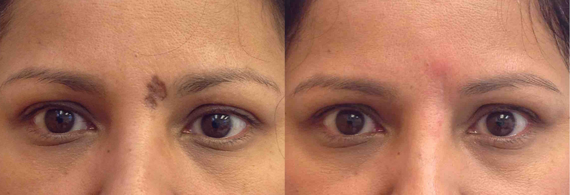 Before and after of a Female patient treated with IPL Laser to improve the appearance of scarring post Mole Removal between eyes.