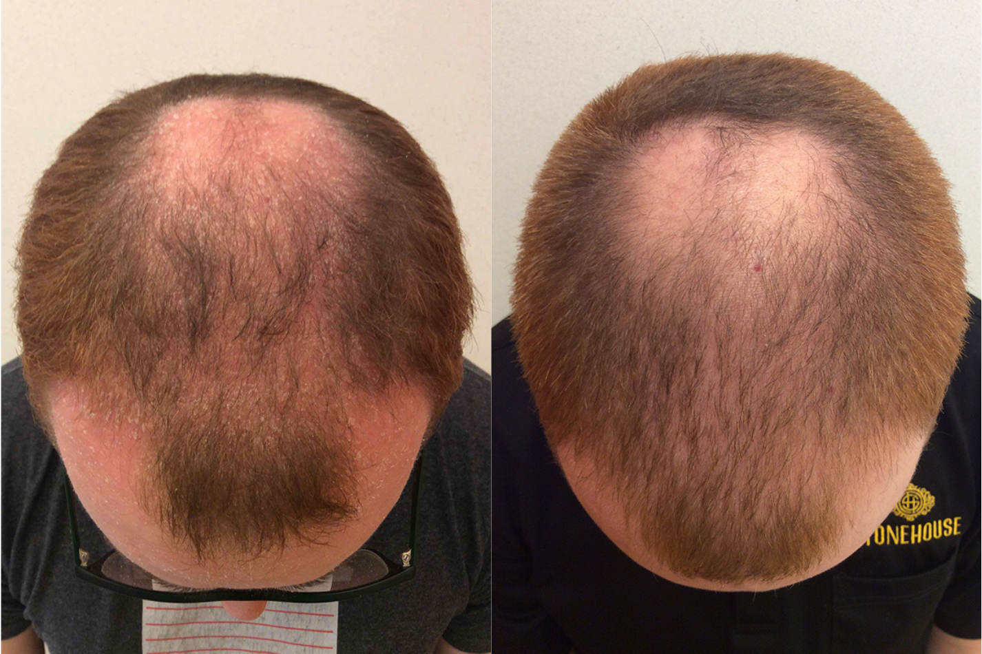 Before and after of a male patient treated for Seborrheic Dermatitis located on the scalp, results; 1.5 Months Post Treatment.