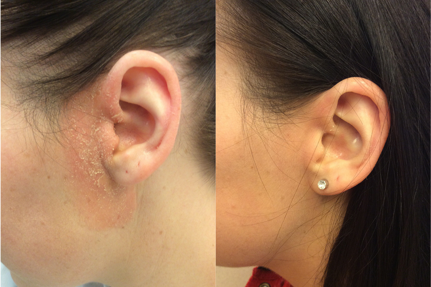 Before and after of a female treated for Seborrheic Dermatitis located on the ear, results; Two Weeks Post Treatment