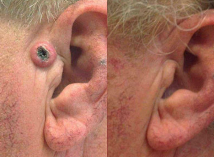 Before and after of a Male patient treated with MOH’s Surgery for Skin Cancer removal to preauricular area.