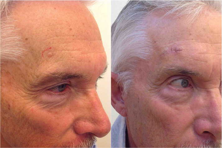 Before and after of a Male patient treated with MOH’s Surgery for Basal Cell Carcinoma Skin Cancer removal located above upper right eyebrow, results; six months post treatment.