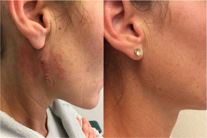 Before and after of a A 42-year-old Female patient treated with MOH’s Surgery for Skin Cancer removal located on right upper jawline.