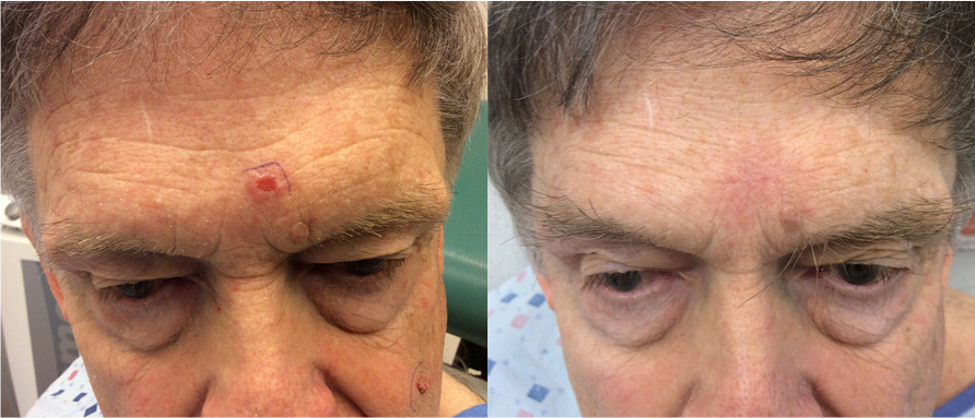 Before and after of a A 79-year-old Male patient treated with MOH’s Surgery for Basal Cell Carcinoma Skin Cancer removal located on forehead.