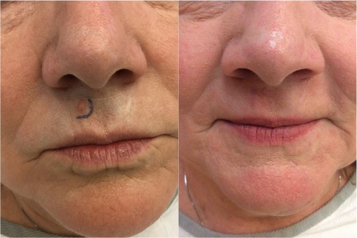 Before and after of a 68-year-old Female patient treated with MOH’s Surgery for Skin Cancer removal located on upper lip.