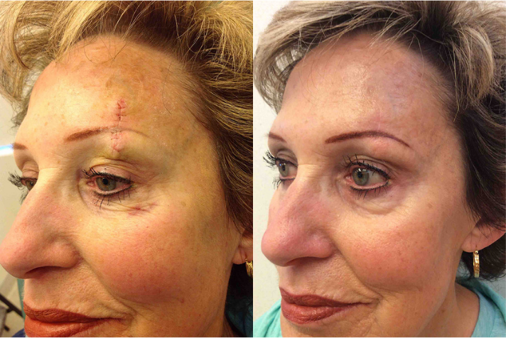 Before and after of a A 71-year-old Female patient treated with MOH’s Surgery for Skin Cancer removal located on the left eyebrow.