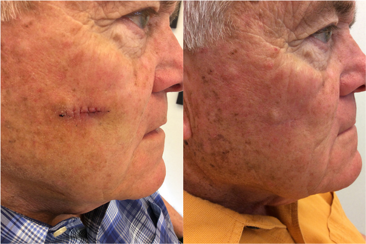 Before and after of a 71-year-old Female patient treated with MOH’s Surgery for Skin Cancer removal located on the left eyebrow.