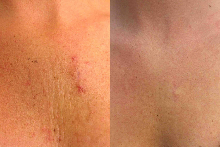 Before and after of a Female patient treated with MOH’s Surgery for Skin Cancer removal located on the chest