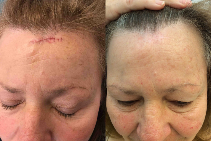 Before and after of a 55-year-old Female patient treated with MOH’s Surgery for Skin Cancer removal located on forehead.