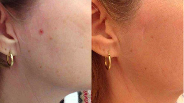 Before and after of a Female patient treated with MOH’s Surgery for Skin Cancer removal to preauricular area.